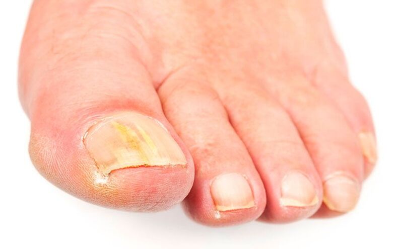 Die Ursachen des Pilzes