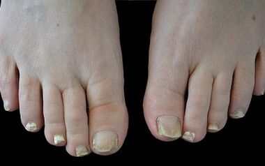 Wie Sie den Pilz an Ihren Fingern loswerden