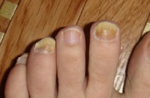 Gelbfärbung des Nagels durch Pilz
