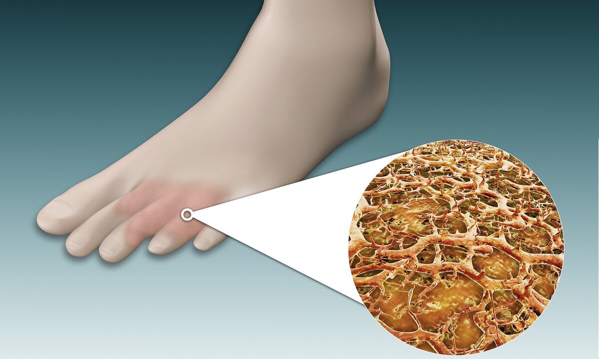 Fußpilzsporen